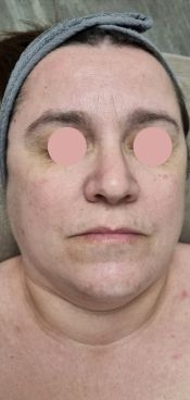 Neocare elite soin double menton avant